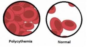 polycythemia namat vera smear